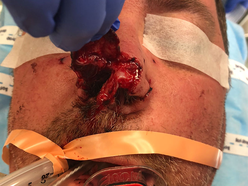 Nasal Reconstruction Before and After | PERK Plastic Surgery