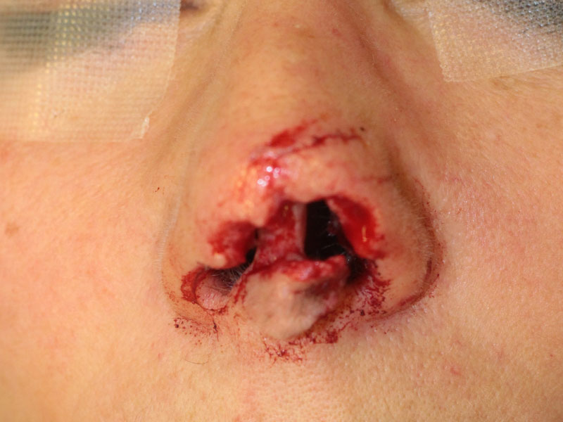 Nasal Reconstruction Before and After | PERK Plastic Surgery