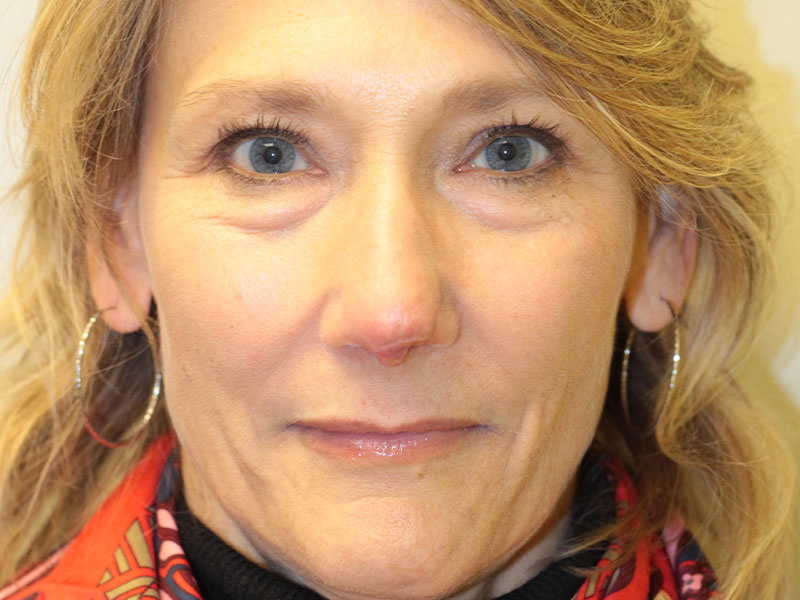 Nasal Reconstruction Before and After | PERK Plastic Surgery