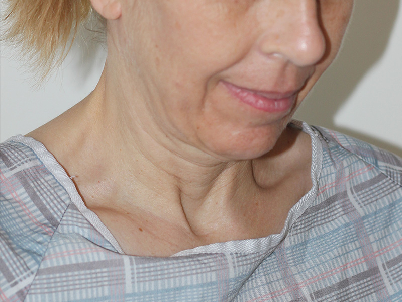 Neck Lift Before and After | PERK Plastic Surgery