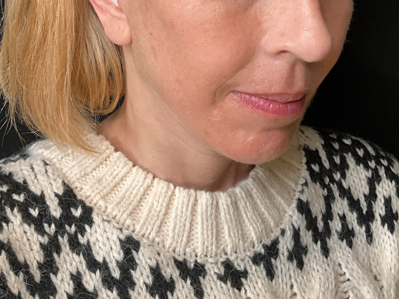 Neck Lift Before and After | PERK Plastic Surgery