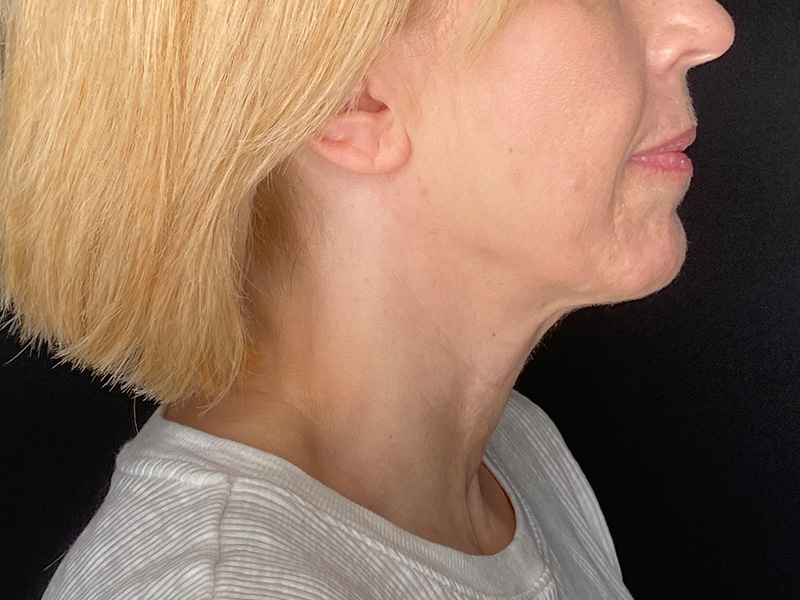 Neck Lift Before and After | PERK Plastic Surgery