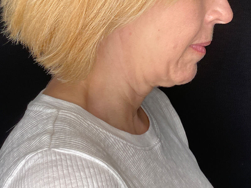 Neck Lift Before and After | PERK Plastic Surgery
