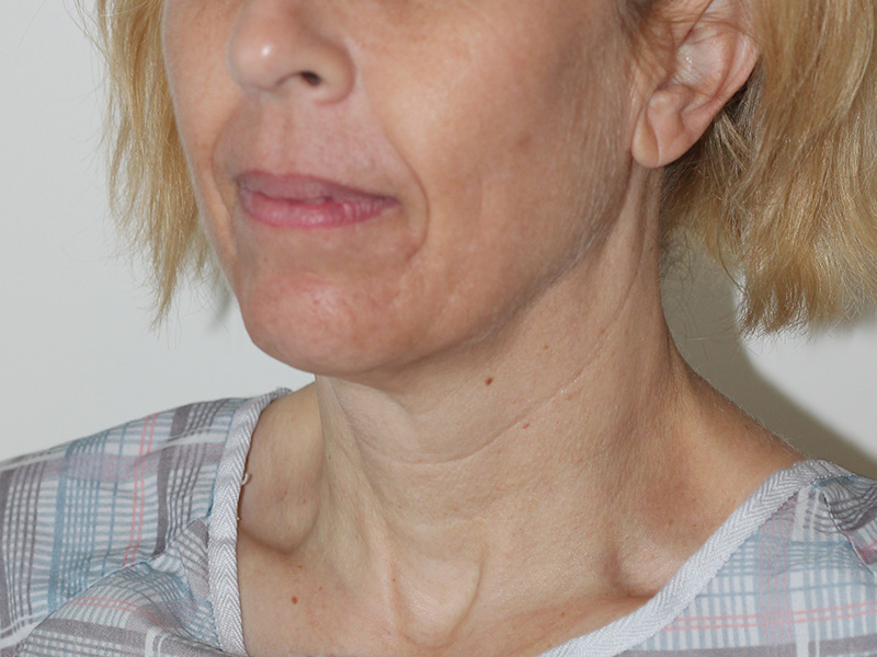 Neck Lift Before and After | PERK Plastic Surgery