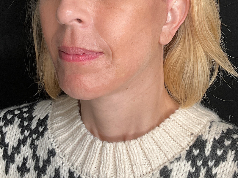 Neck Lift Before and After | PERK Plastic Surgery