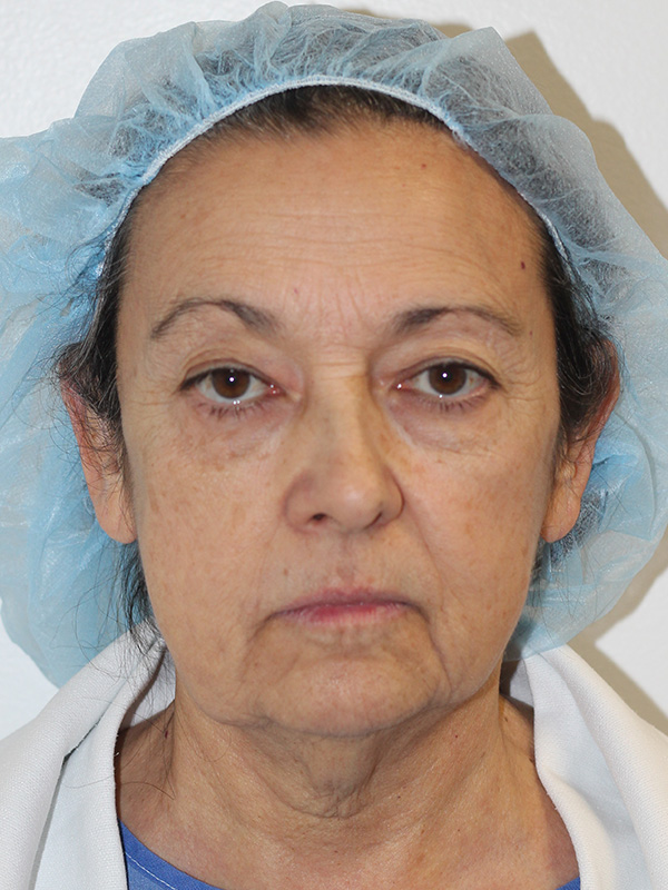 Neck Lift Before and After | PERK Plastic Surgery