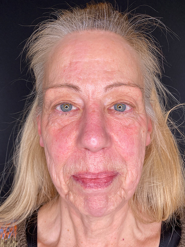 Neck Lift Before and After | PERK Plastic Surgery