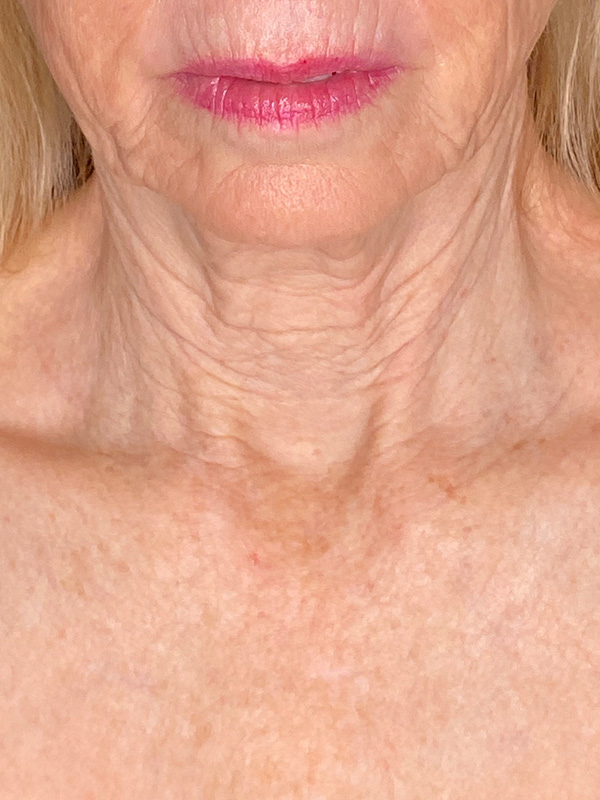 Neck Lift Before and After | PERK Plastic Surgery