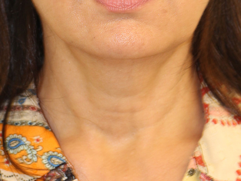 Neck Lift Before and After | PERK Plastic Surgery
