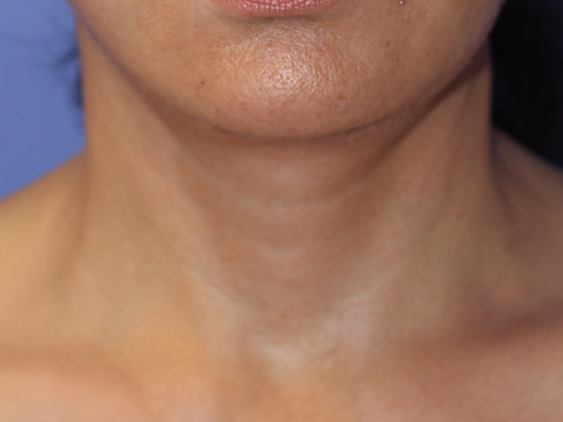 Neck Lift Before and After | PERK Plastic Surgery
