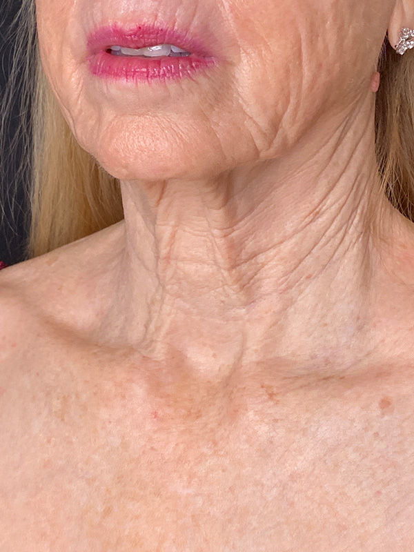 Neck Lift Before and After | PERK Plastic Surgery