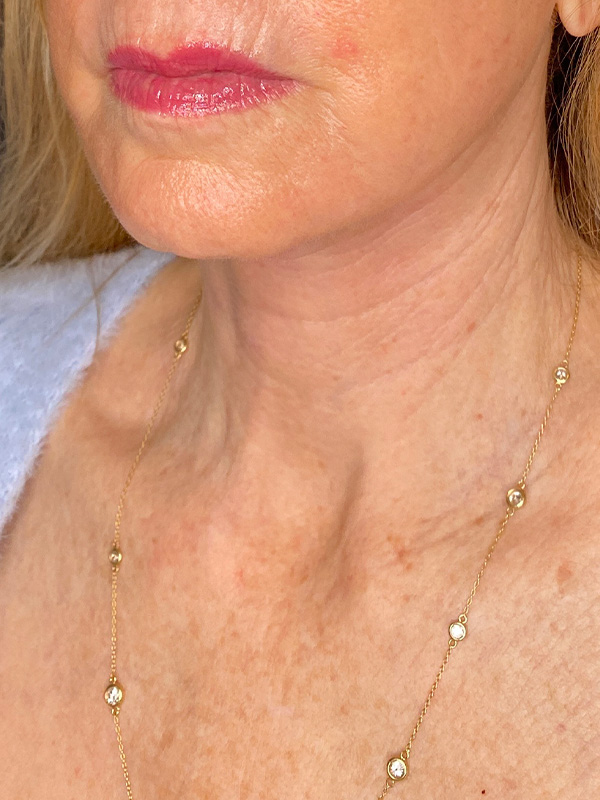 Neck Lift Before and After | PERK Plastic Surgery