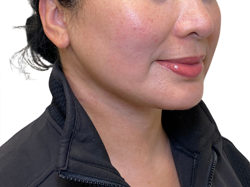 Neck Lift Before and After | PERK Plastic Surgery