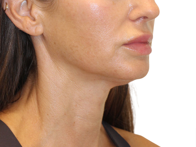Neck Lift Before and After | PERK Plastic Surgery
