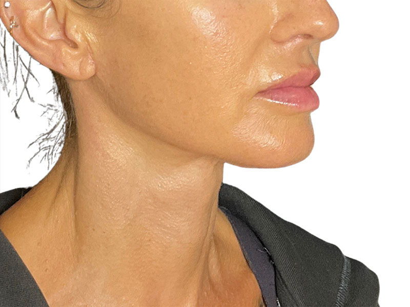Neck Lift Before and After | PERK Plastic Surgery