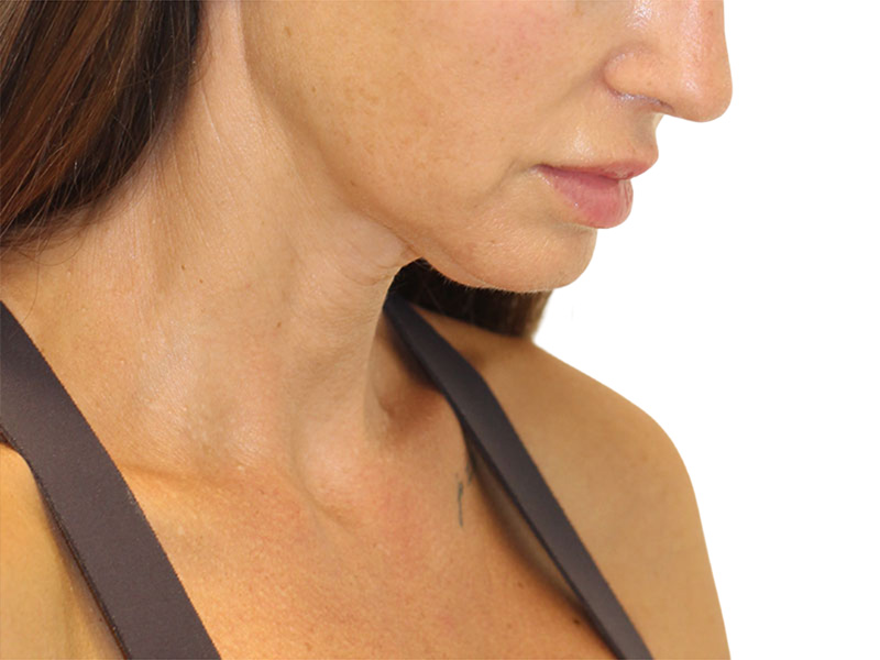 Neck Lift Before and After | PERK Plastic Surgery