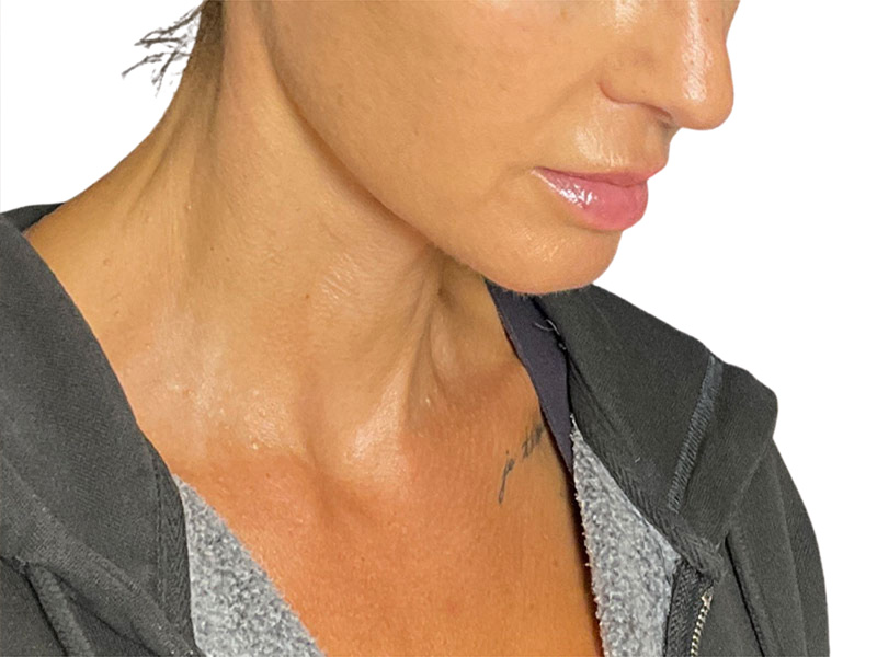 Neck Lift Before and After | PERK Plastic Surgery
