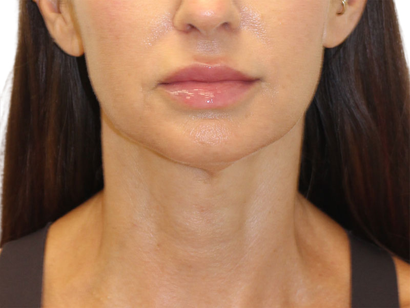 Neck Lift Before and After | PERK Plastic Surgery