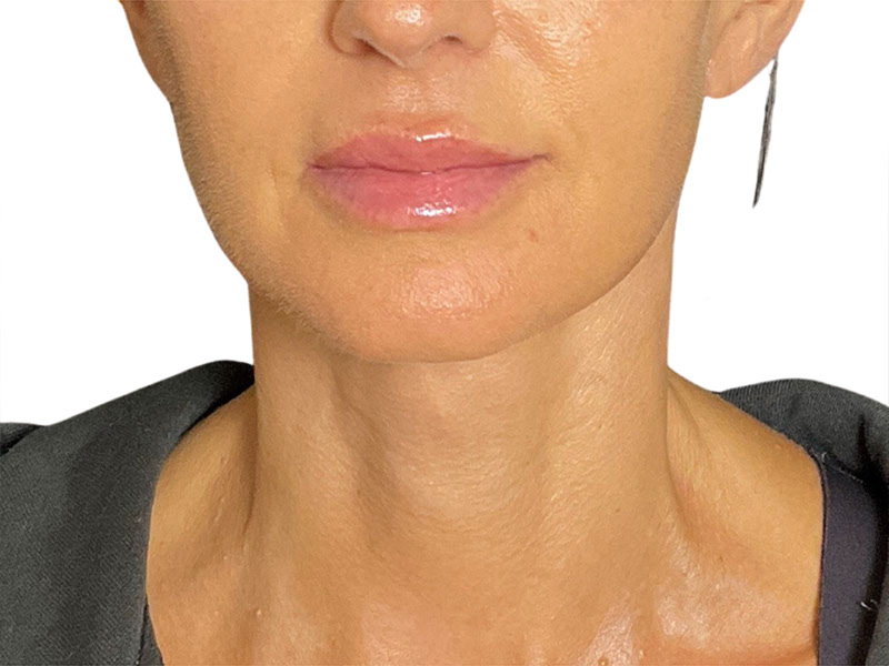Neck Lift Before and After | PERK Plastic Surgery