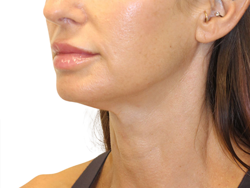 Neck Lift Before and After | PERK Plastic Surgery