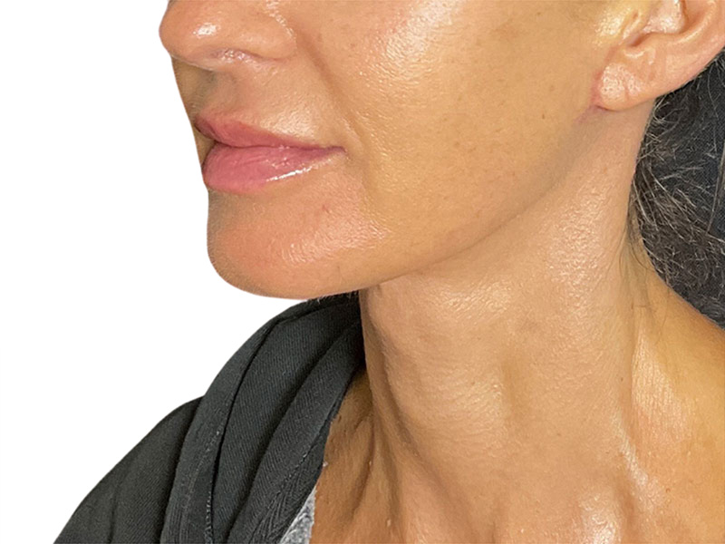 Neck Lift Before and After | PERK Plastic Surgery
