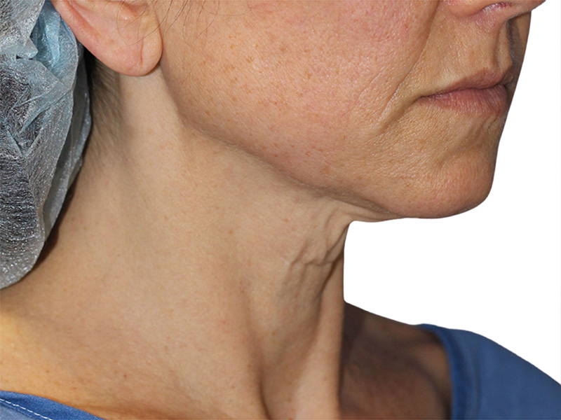 Neck Lift Before and After | PERK Plastic Surgery