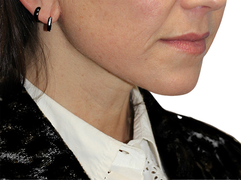 Neck Lift Before and After | PERK Plastic Surgery
