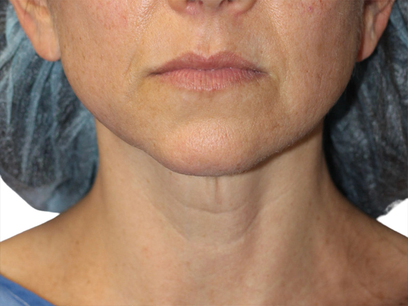 Neck Lift Before and After | PERK Plastic Surgery