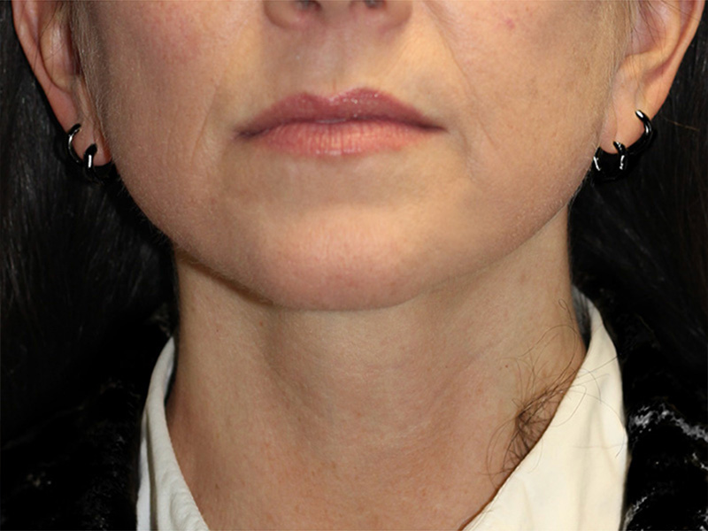 Neck Lift Before and After | PERK Plastic Surgery