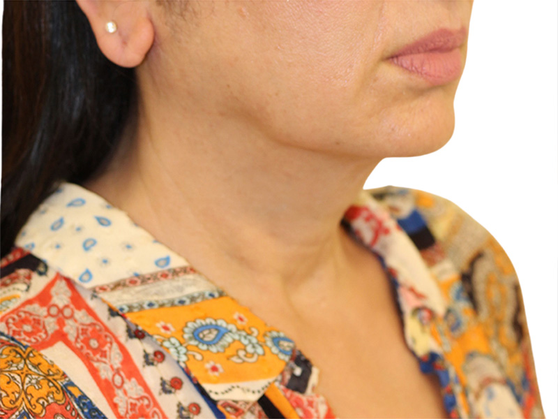 Neck Lift Before and After | PERK Plastic Surgery