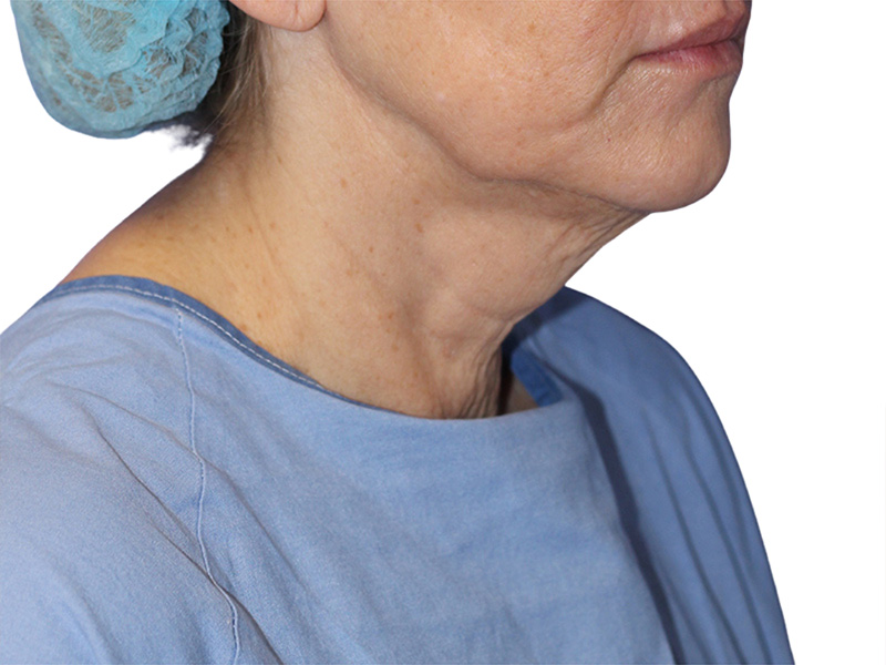 Neck Lift Before and After | PERK Plastic Surgery
