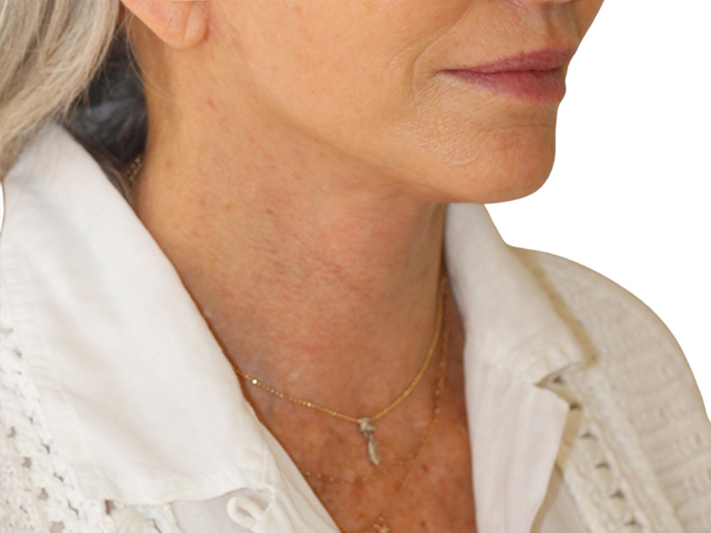 Neck Lift Before and After | PERK Plastic Surgery