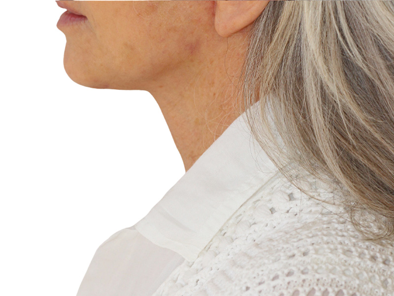 Neck Lift Before and After | PERK Plastic Surgery