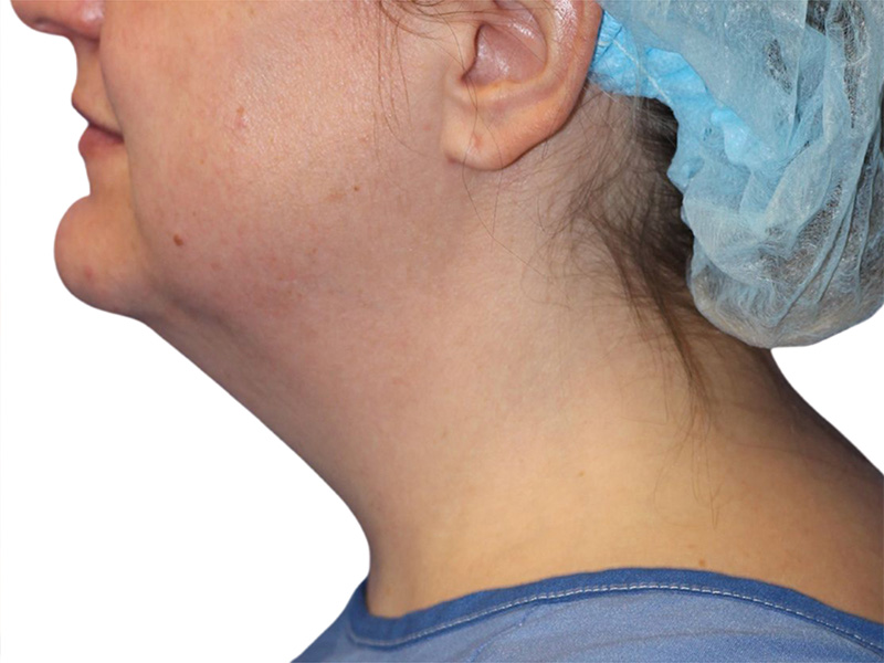 Neck Lift Before and After | PERK Plastic Surgery
