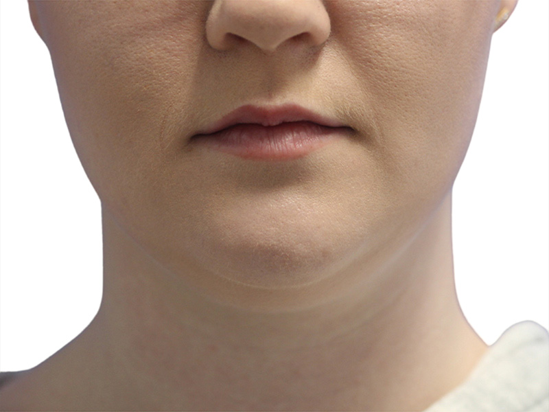 Neck Liposuction Before and After | PERK Plastic Surgery