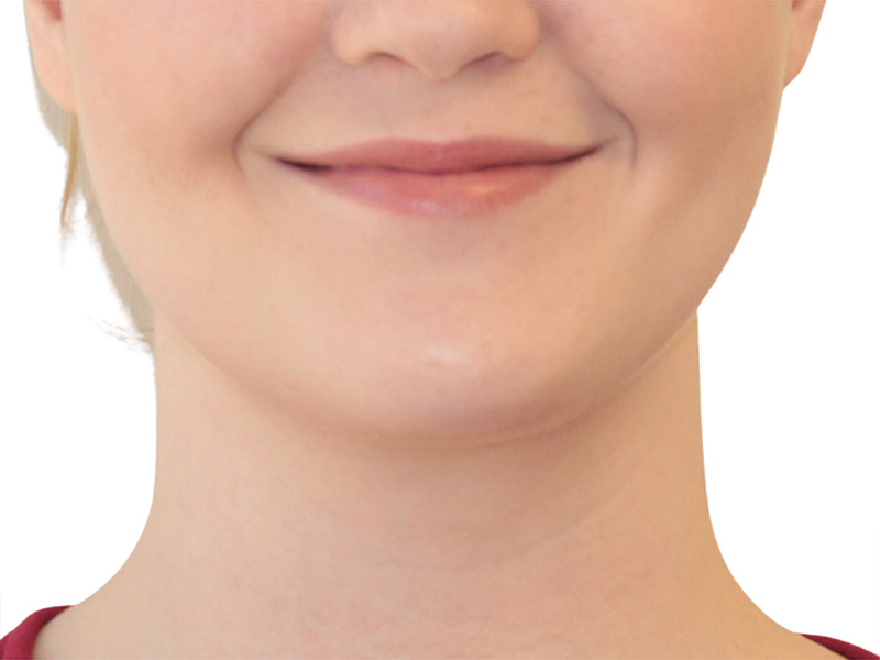 Jawline Contouring Beverly Hills