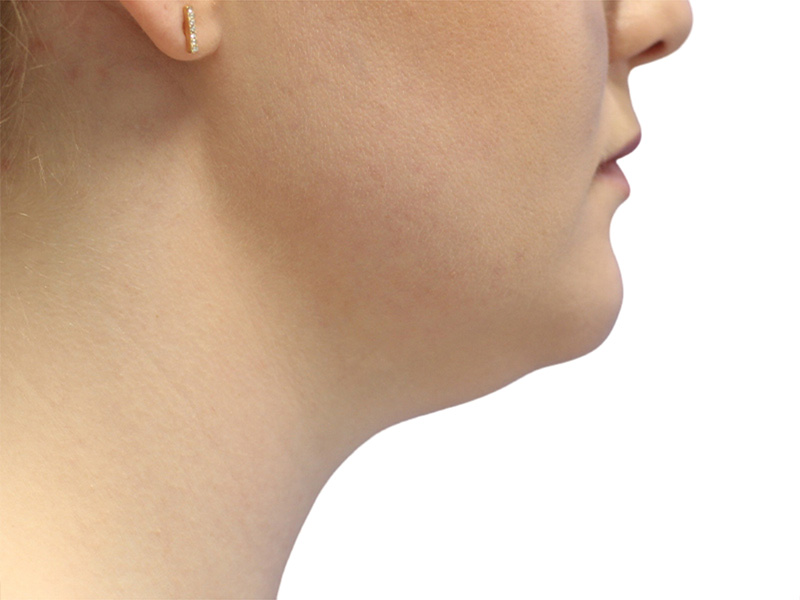 Neck Liposuction Before and After | PERK Plastic Surgery