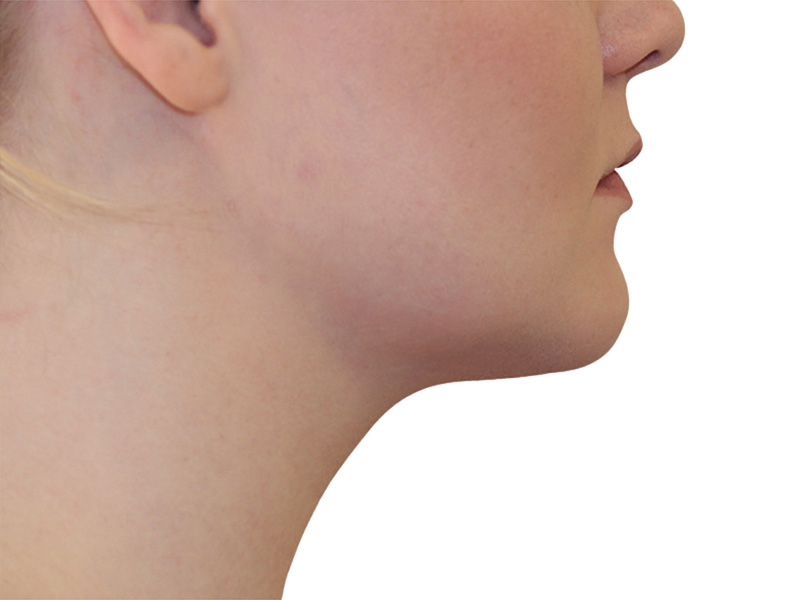 Neck Liposuction Before and After | PERK Plastic Surgery