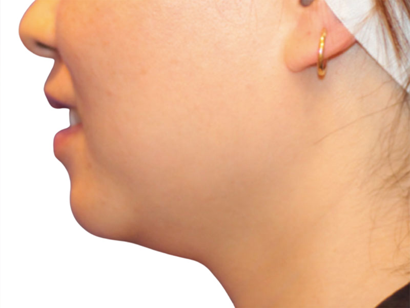 Neck Liposuction Before and After | PERK Plastic Surgery