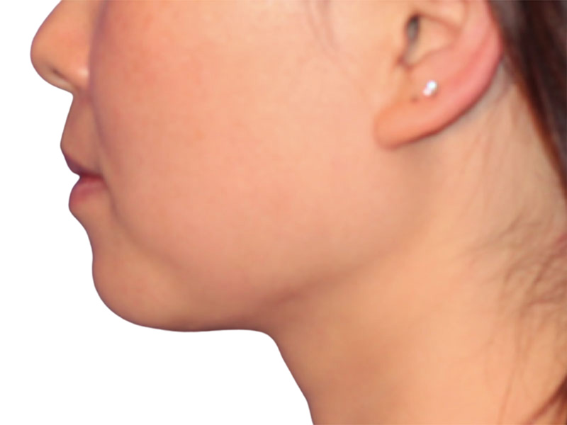 Jawline Contouring Beverly Hills