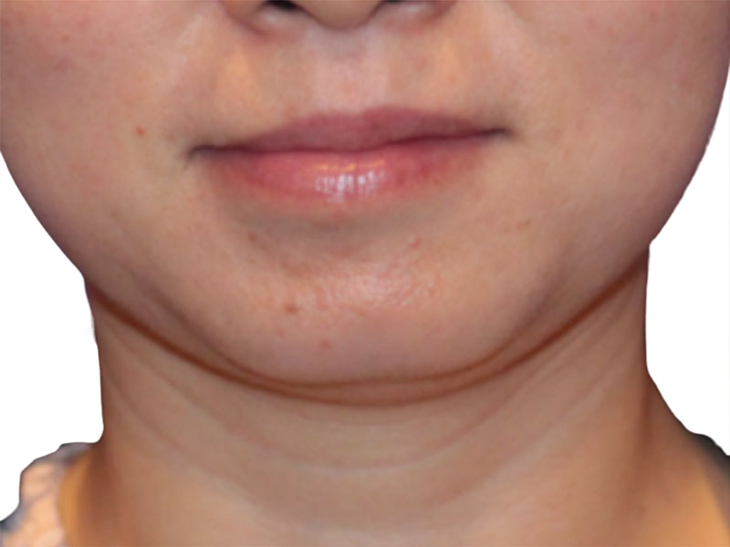 Neck Liposuction Before and After | PERK Plastic Surgery