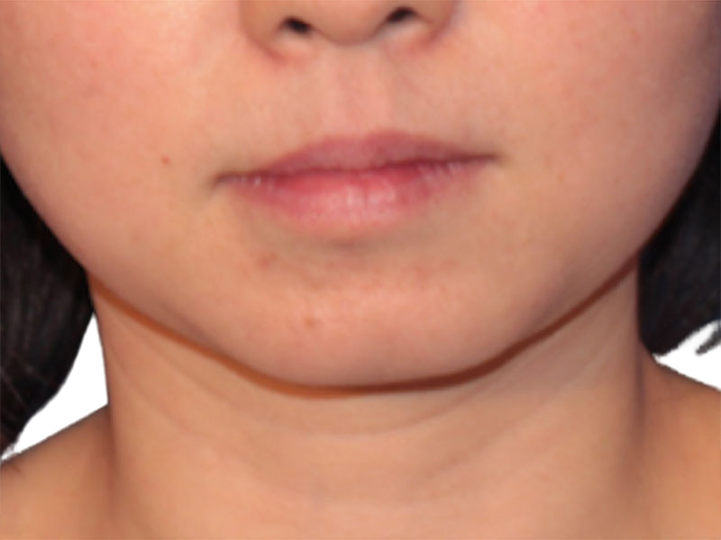 Neck Liposuction Before and After | PERK Plastic Surgery
