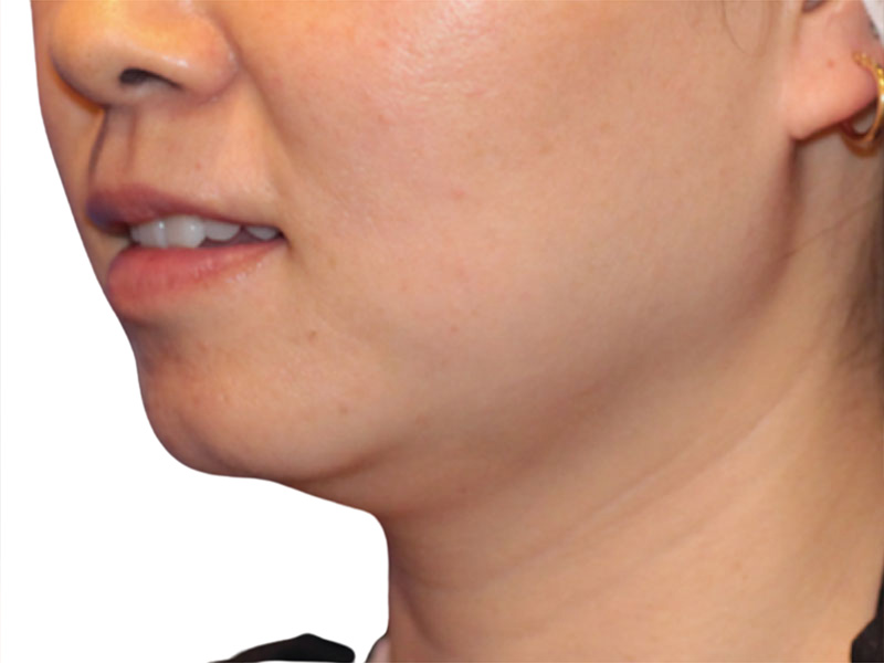 Neck Liposuction Before and After | PERK Plastic Surgery