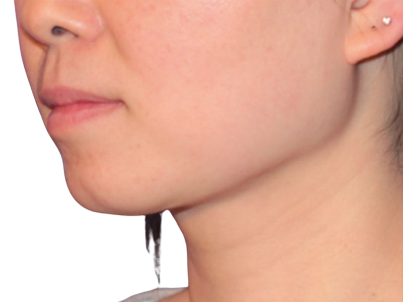 Neck Liposuction Before and After | PERK Plastic Surgery