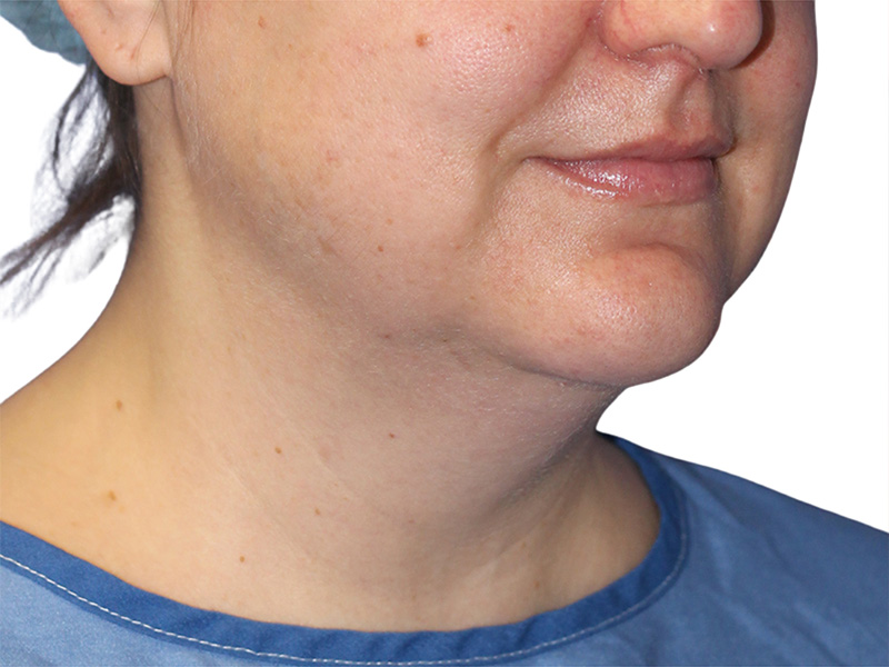 Neck Liposuction Before and After | PERK Plastic Surgery