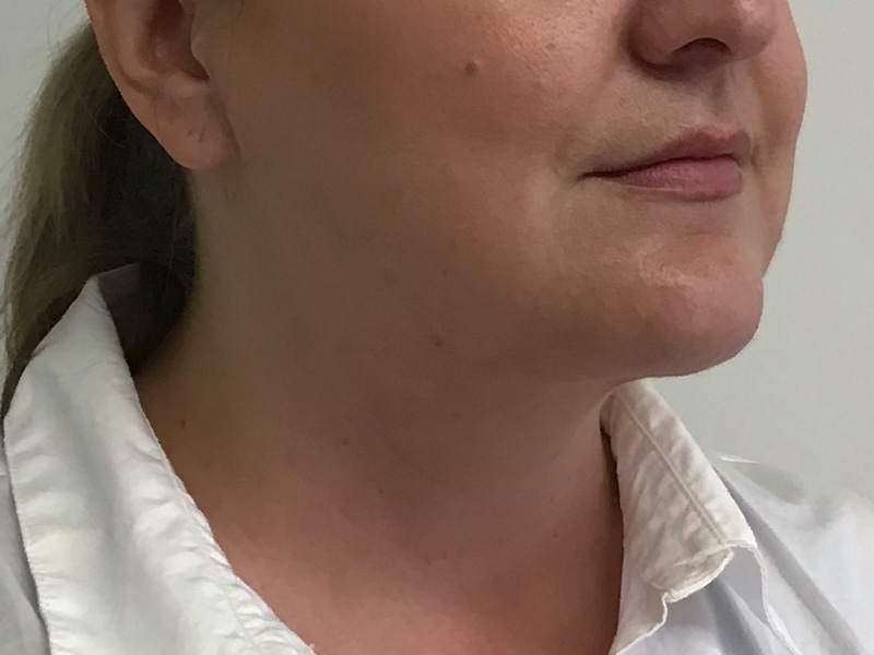 Neck Liposuction Before and After | PERK Plastic Surgery