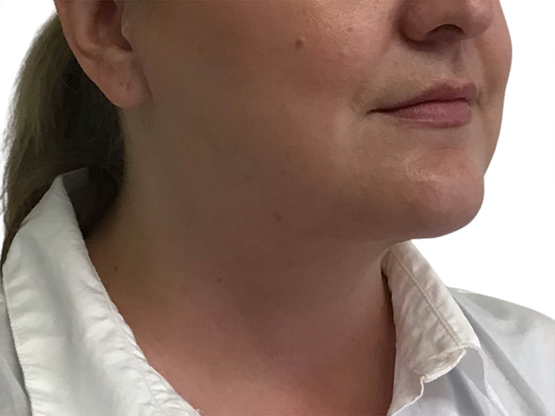 Neck Liposuction Before and After | PERK Plastic Surgery