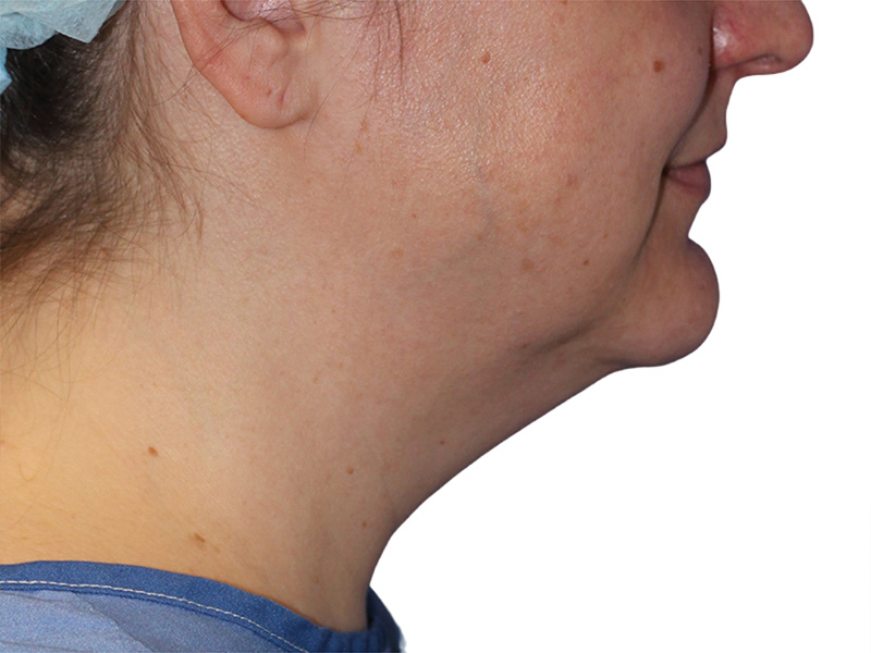 Neck Liposuction Before and After | PERK Plastic Surgery