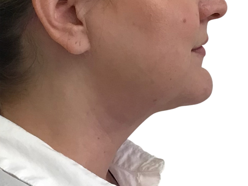 Neck Liposuction Before and After | PERK Plastic Surgery