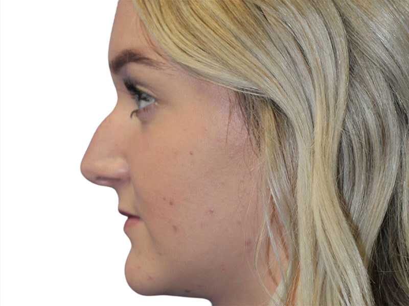 Rhinoplasty Beverly Hills